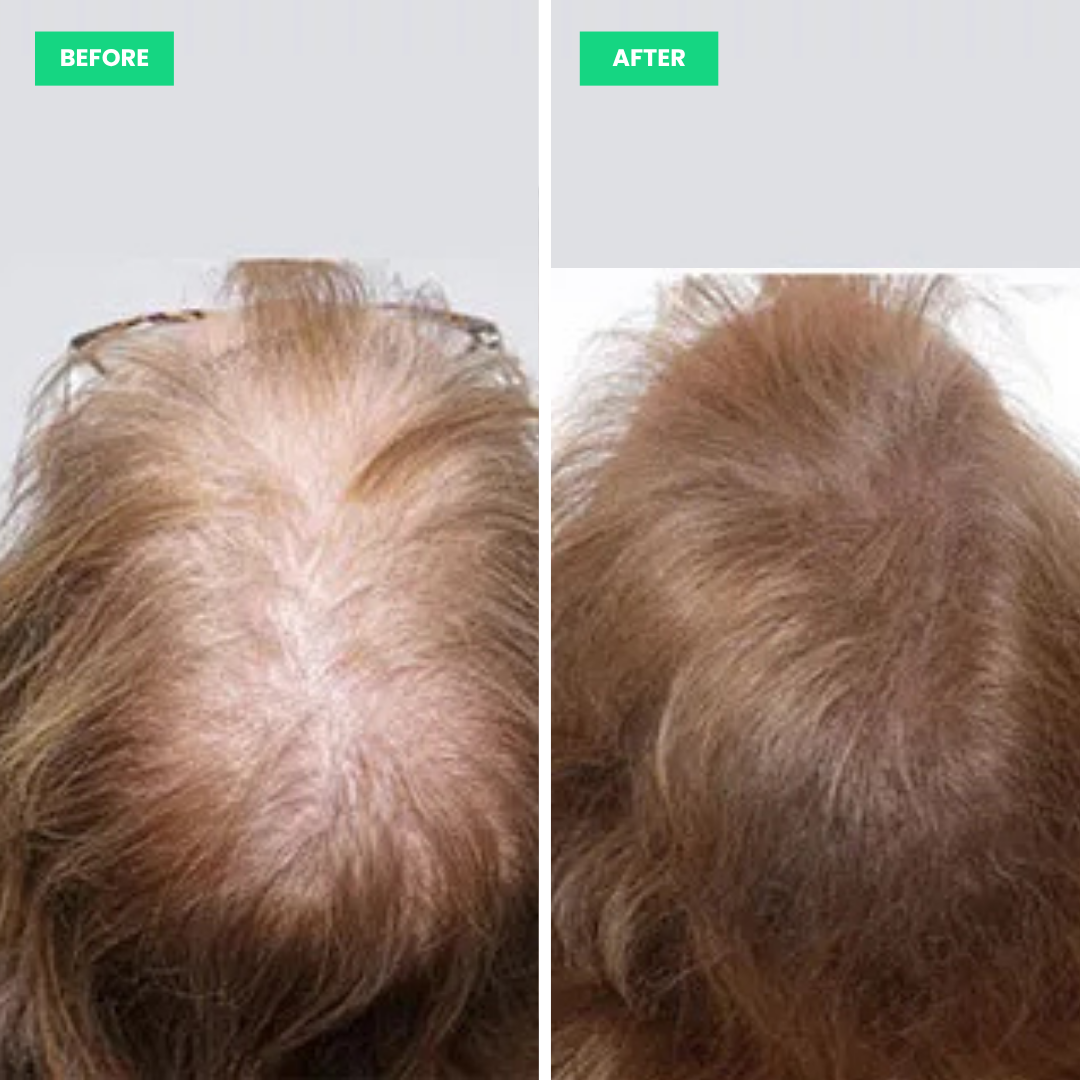 HairSprout LED Cap Hair Growth System