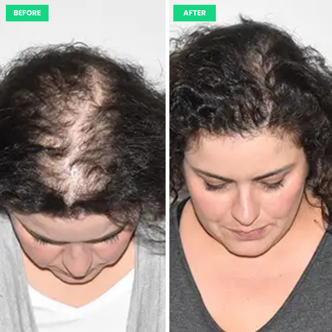 HairSprout LED Cap Hair Growth System